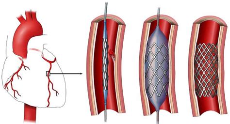 Stent Placement Heart And Vascular Care New Jersey
