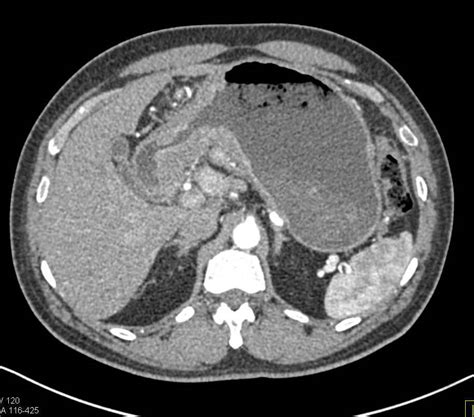 Carcinoma Of The Gastric Antrum Stomach Case Studies Ctisus Ct Scanning