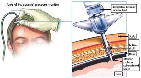 Intracranial Pressure Monitoring Icp