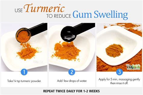 Home Remedies To Reduce Gum Swelling Top 10 Home Remedies