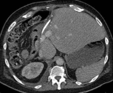 Contrast Enhanced Ct Following Extended Right Hepatectomy With