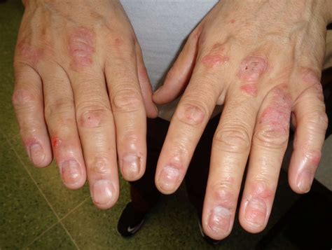 Dermdx Itchy Patches On The Hands Dermatology Advisor