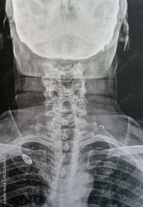 Foto Stock Plain X Ray Cervical Vertebrae Showing Straightening Of