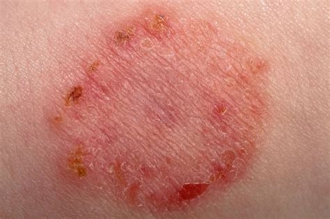 Skin Rashes That Look Like Ringworm