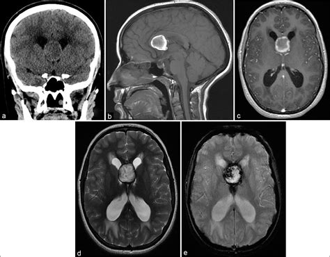 Unusual Vascular Anatomical Variant Leads To Spontaneous Hemorrhage In