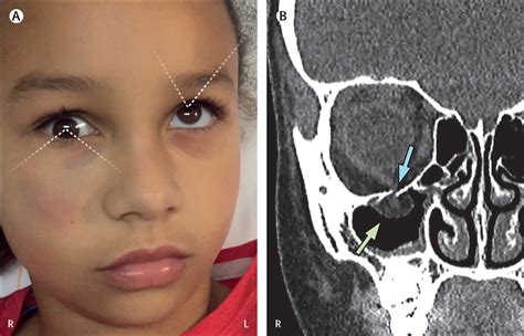 Football Causes Orbital Trapdoor Fracture With Restricted Eye Movement