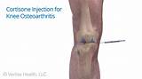 Photos of Alternative Treatments For Arthritis Knee Pain