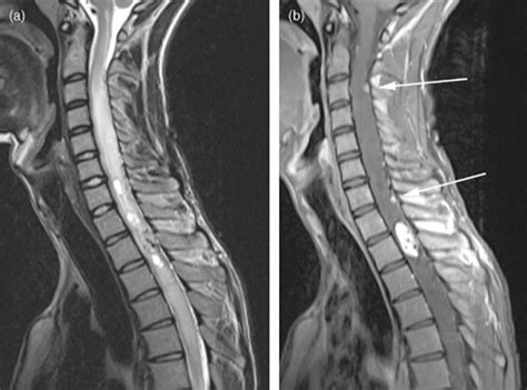 Spinal Lesions On Mri