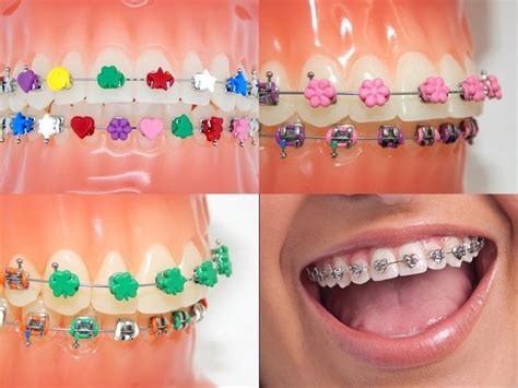 Trendy And Fashionable Teeth Braces Ideas Colorful Teeth Braces