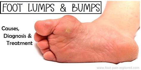 Lump On Top Of Foot Common Causes Treatment Artofit