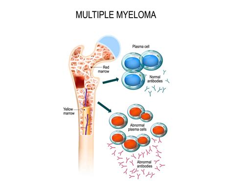 Multiple Myeloma Diag Tec Preclinical CRO In MM