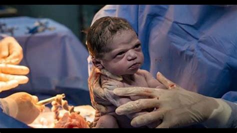 Angry Newborn Baby Stares At Doctor In Brazil Photo Goes Viral