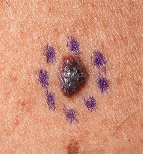 Photograph Skin Cancer Malignant Melanoma Science Source Images