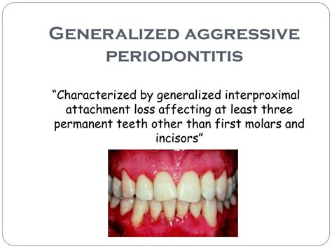 Ppt Aggressive Periodontitis Powerpoint Presentation Free Download