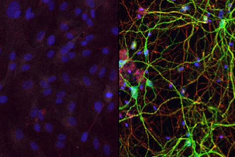 Skin Cells Converted Directly To Neurons In Effort To Reverse