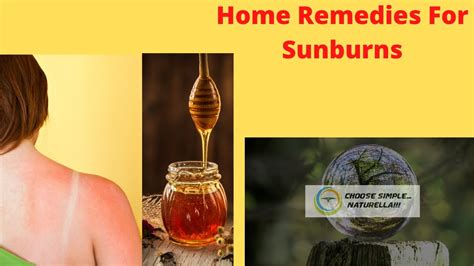 Home Remedies For Sunburns Youtube