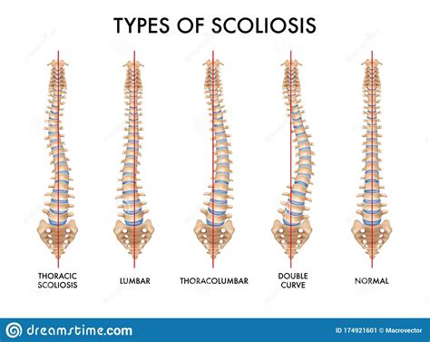 Vertebral Escoliosis Columna Colonne Vertebrale Scoliosis Soporte Sexiz Pix