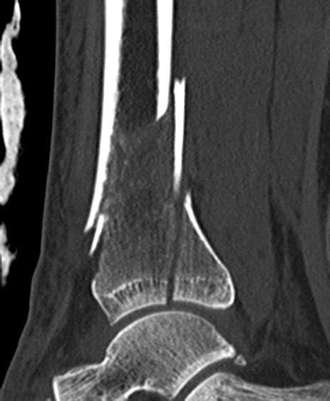 Distal Tibial Fractures The Bone School