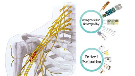 Introduction To Compression Neuropathies Feat Dr Mackinnon Youtube