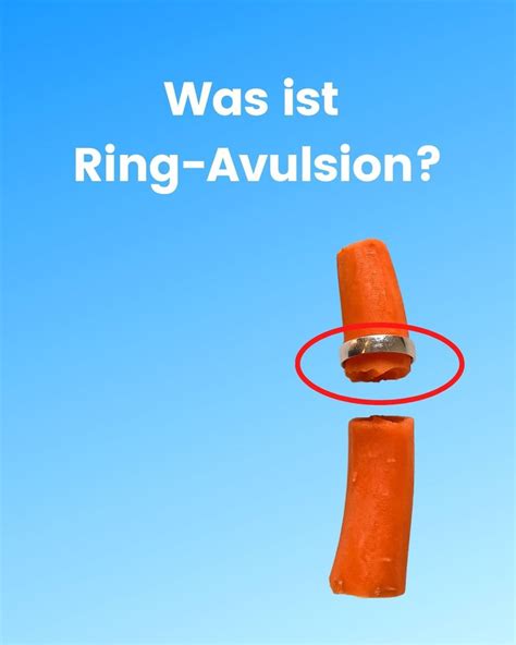 Was Ist Ring Avulsion Solid Rings