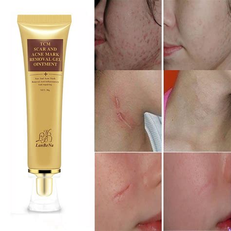 Scar Acnes Keloid Repairs Stretch Gel Cream Marks Skin Burns Removal