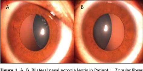 Ectopia Lentis In Marfan Syndrome Captions Profile