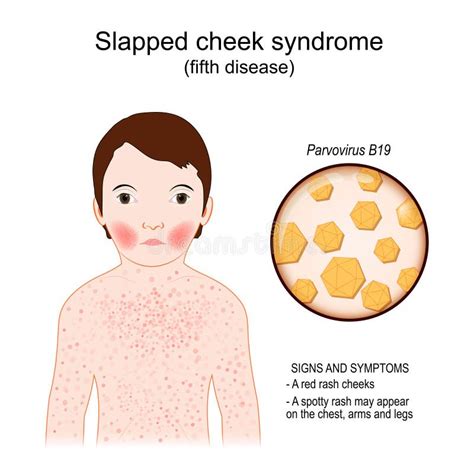 Child Has Slapped Cheek Syndrome Infectious Disease Stock Vector