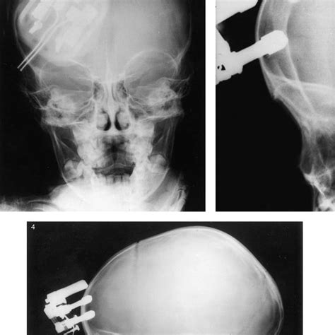 Anteroposterior Lateral And Tangential View Skull Radiographs Showing