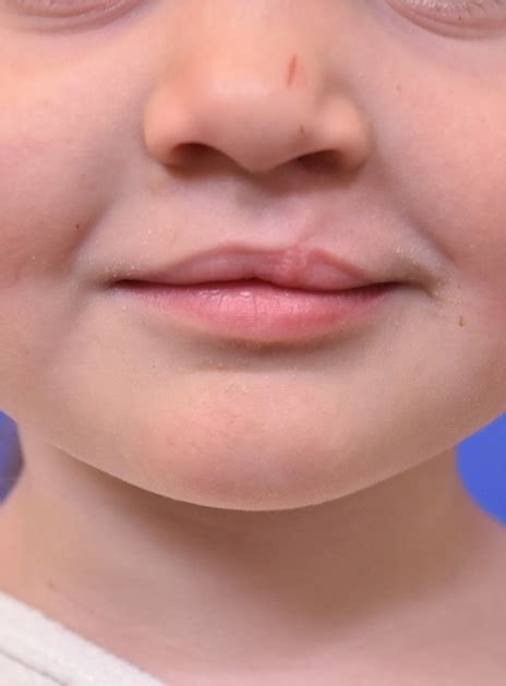 Cleft Lip And Palate Houston Cranio Facial