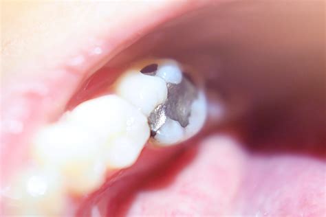 Now your tooth hurts when it didn't hurt before. should I replace my silver (amalgam) fillings ...