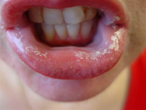 Fungal infections are caused by fungi, tiny microbes * found in soil, air, and water, as well as on plants, animals, and people. Fungal Infection Inside Lips | Ownerlip.co