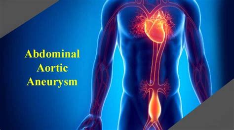 Abdominal Aortic Aneurysm Causes Symptoms Treatments And Main Risk