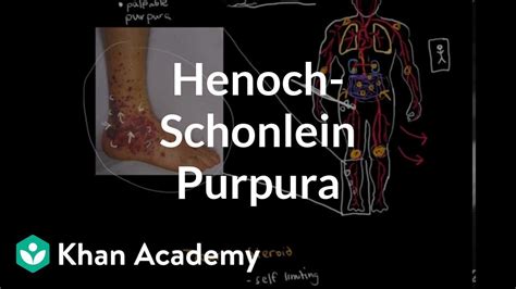 Henoch Schonlein Purpura Circulatory System And Disease Nclex Rn