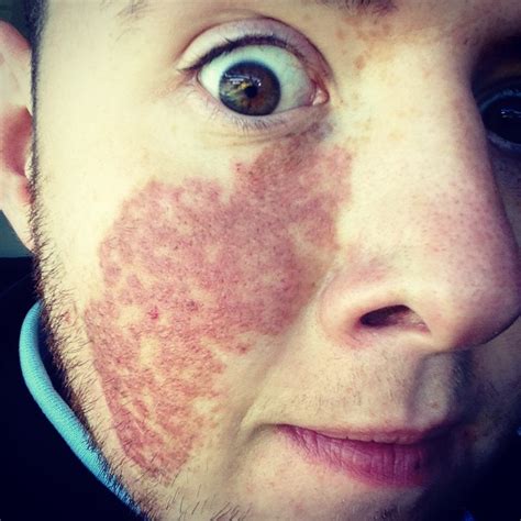 These 19 Stunning Photos Prove That Birthmarks Are Beautiful Huffpost