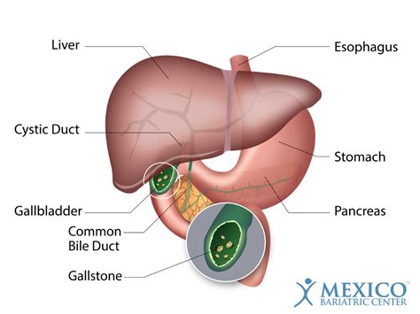 How You Know You Have Gallstones Signs Symptoms Treatment