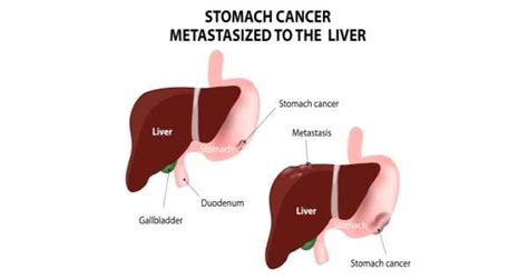 Stomach cancer arises in the lining of the stomach. Stomach cancer and Health - Health Tips, Stomach cancer ...