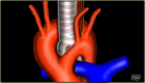 The Radiology Assistant Vascular Anomalies Of Aorta Pulmonary And