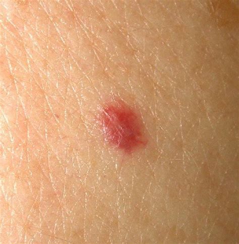 Cherry Angiomas Pictures Symptoms Causes Treatment Removal Hubpages