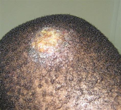 Tinea Capitis Ringworm — Hair Medicine Institute