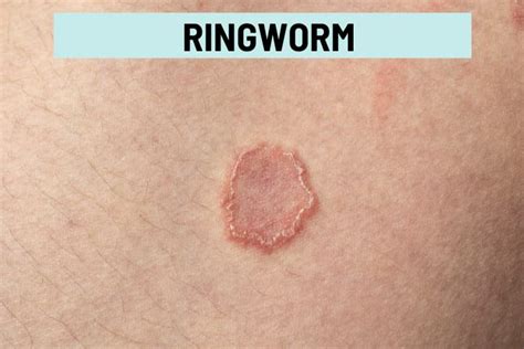 Itchy Bumps On Skin 21 Causes Pictures And Treatment