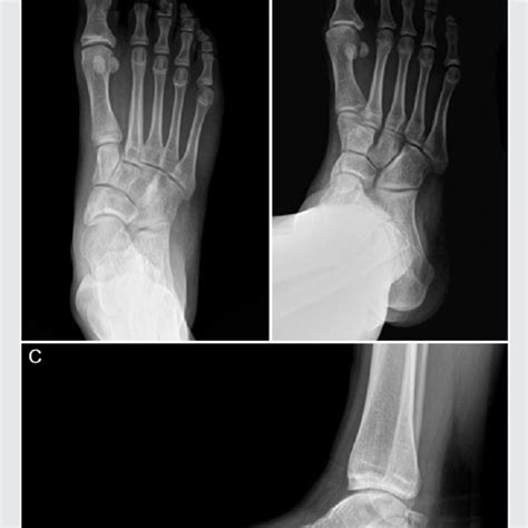 Pdf Evaluation Of Tarsal Navicular Stress Fracture Fixation Using