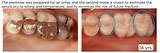 Photos of Craze Lines In Teeth Treatment