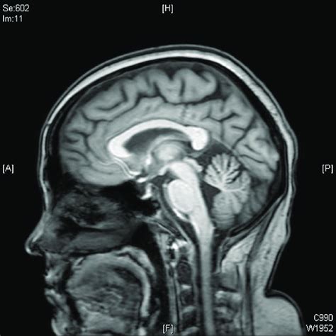 A T2 Weighted Flair Mri Of The Brain Showing Normal Pituitary With No