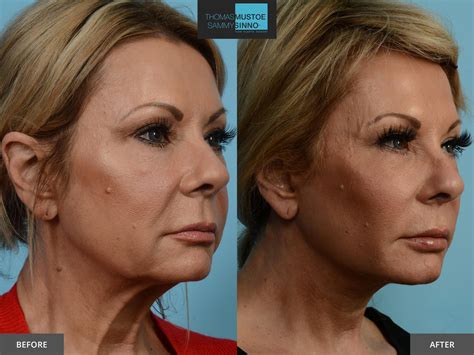 8 Facelift Before And After Photos That Prove Just How Natural Todays