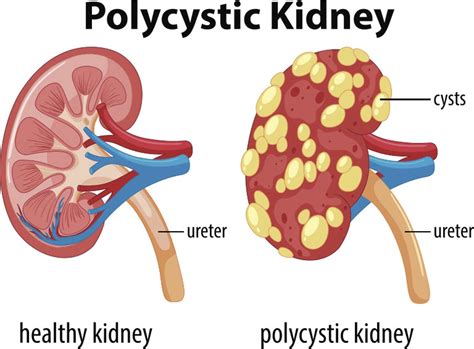 Pin On Kidney Disease