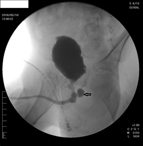 Follow Up Micturating Cystourethrogram Following Posterior Urethral