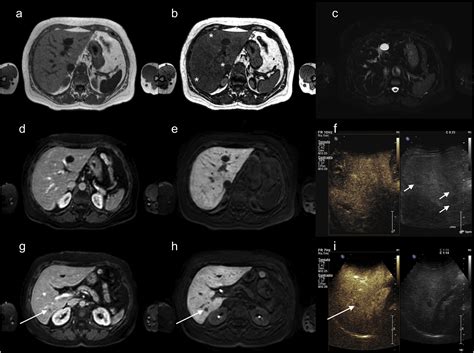 Multiple Liver Pseudotumors Due To Hepatic Steatosis And Fatty Sparing
