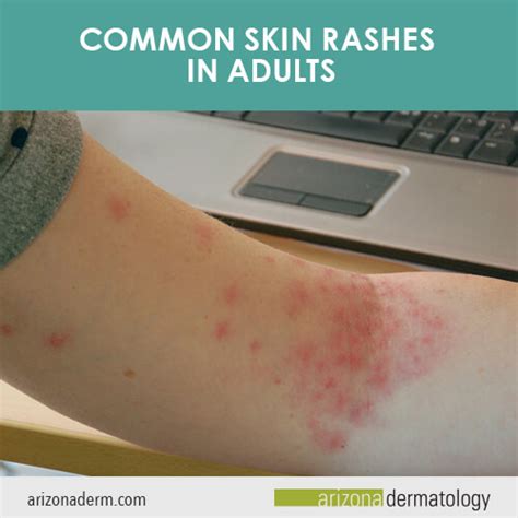 Common Skin Rashes In Adults
