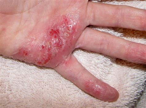 Severe Eczema This Is My 6 Year Old Sons Hand He Has Am Flickr
