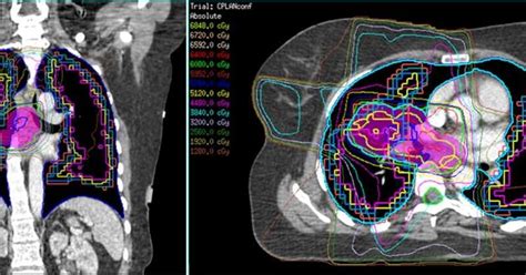 How Ct Scans Continue To Play A Fundamental Role In Cancer Treatment